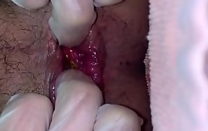 Self dilation be incumbent on anal sphincter