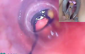 Mature Woman Peehole Endoscope Camera in Bladder with Drool